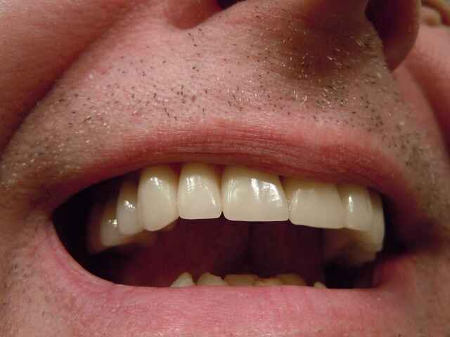 Are yellow teeth genetic