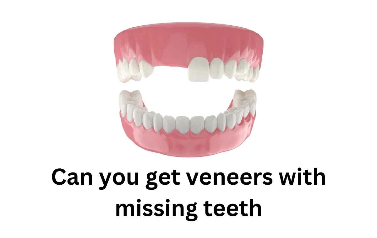 Can you get veneers with missing teeth​