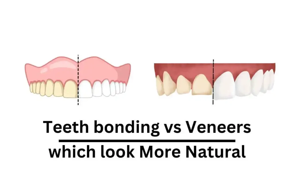 Teeth bonding vs Veneers - What looks more natural