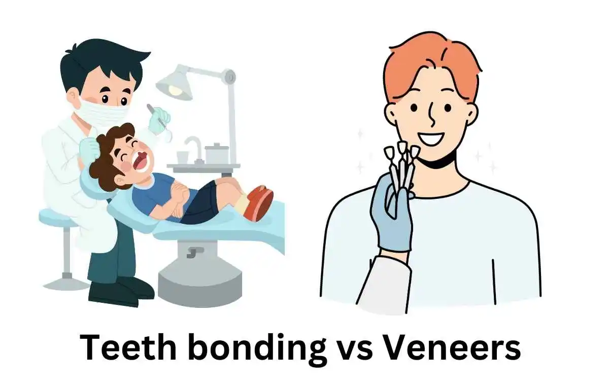 Teeth bonding vs Veneers​